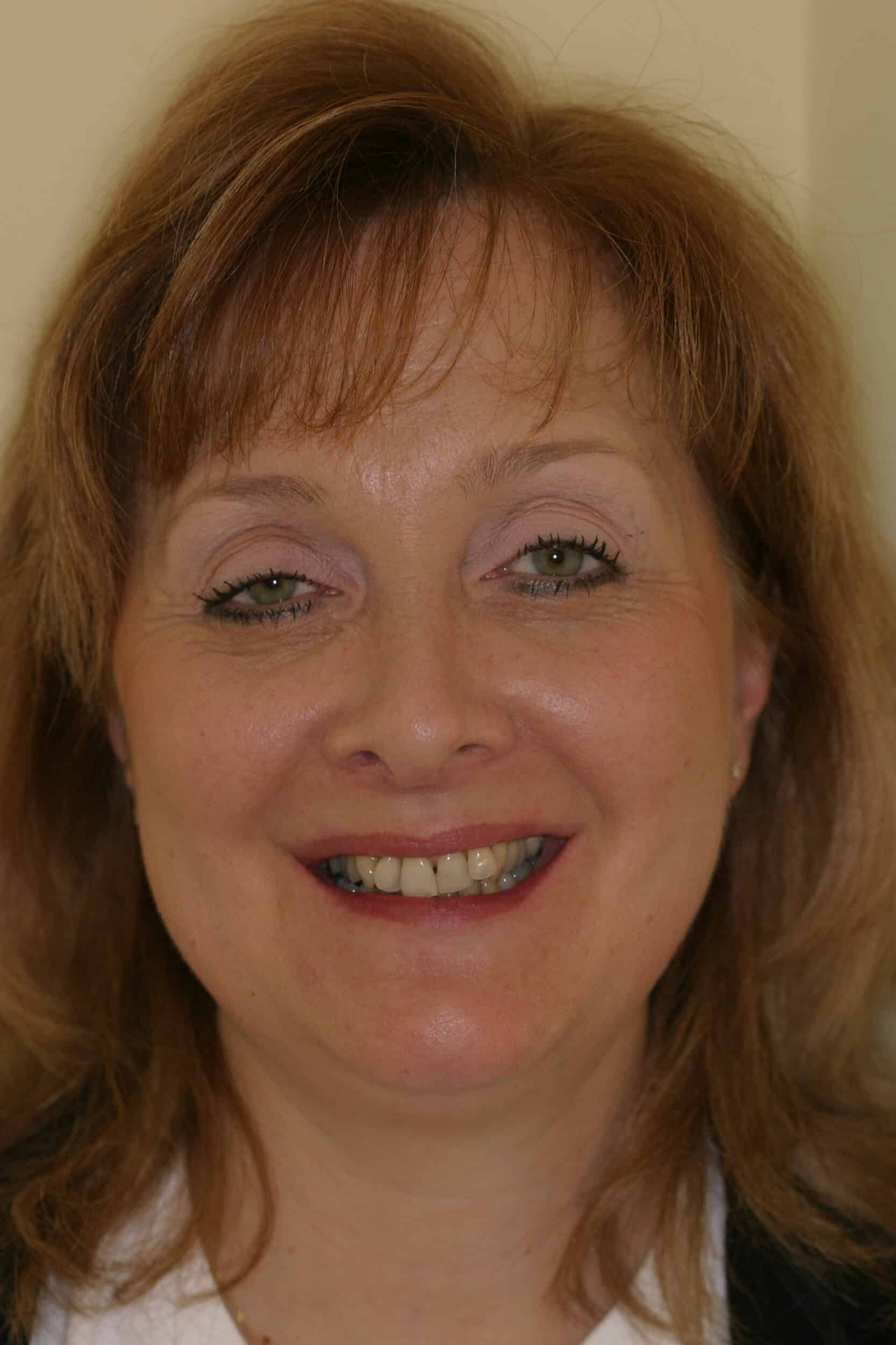 Before Image: Veneers - front
