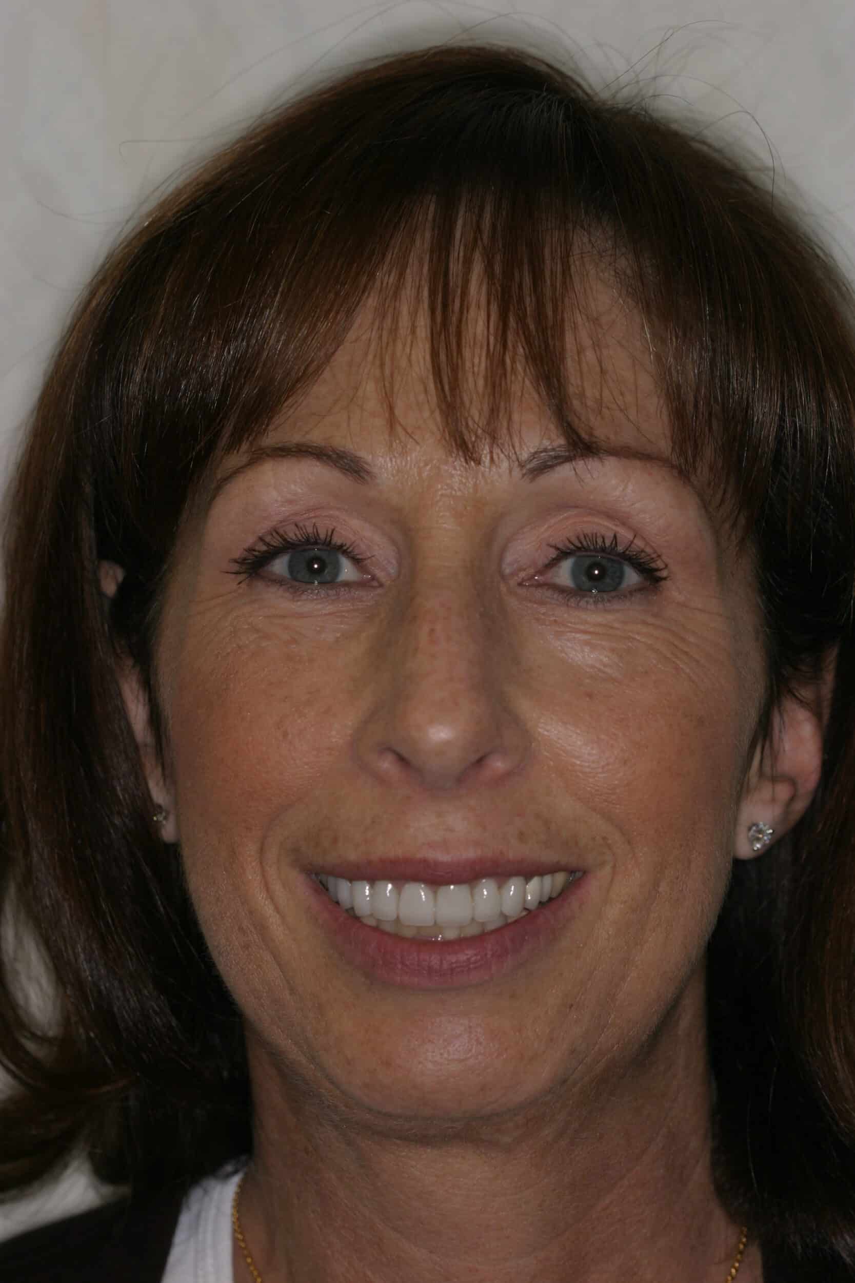 After Image: Veneers - front