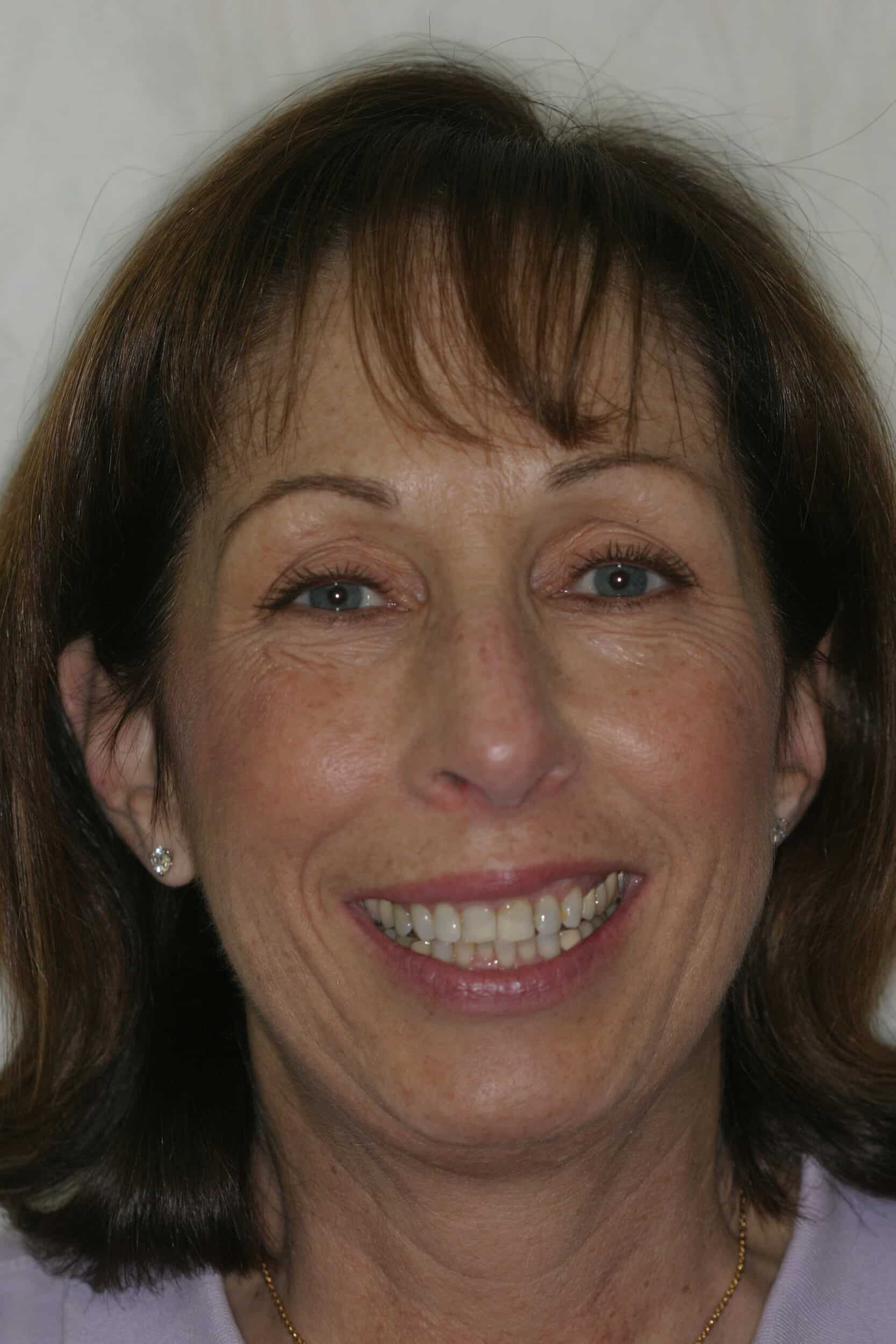 Before Image: Veneers - front