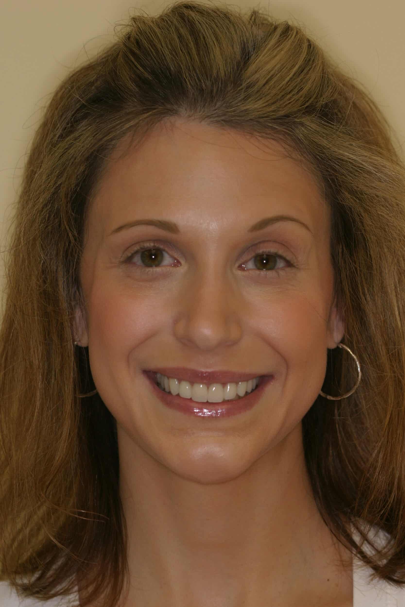 After Image: Veneers - front