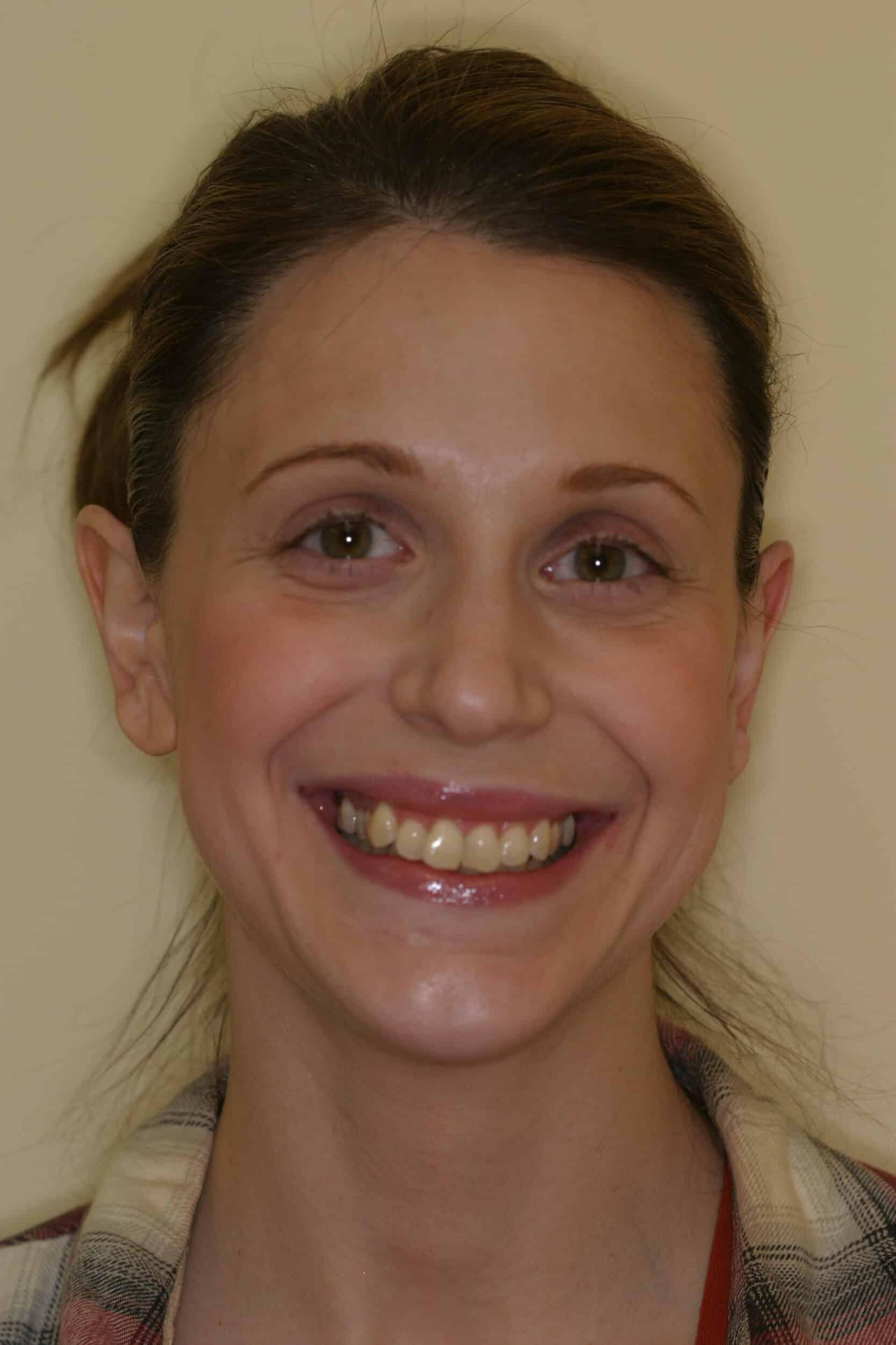 Before Image: Veneers - front