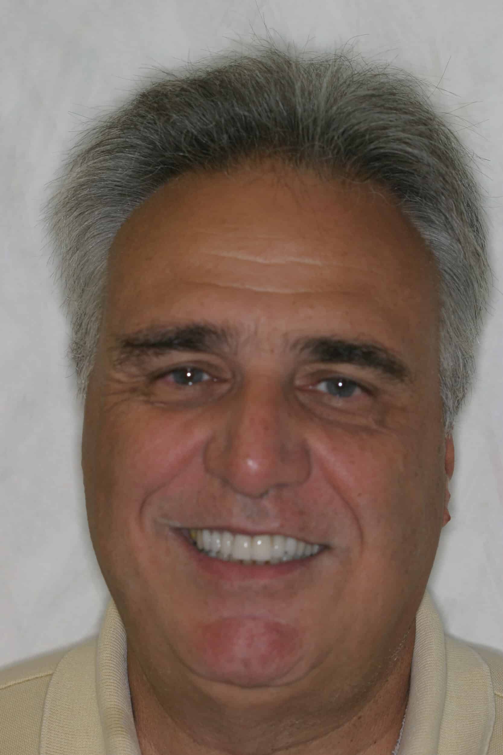 After Image: Veneers - front