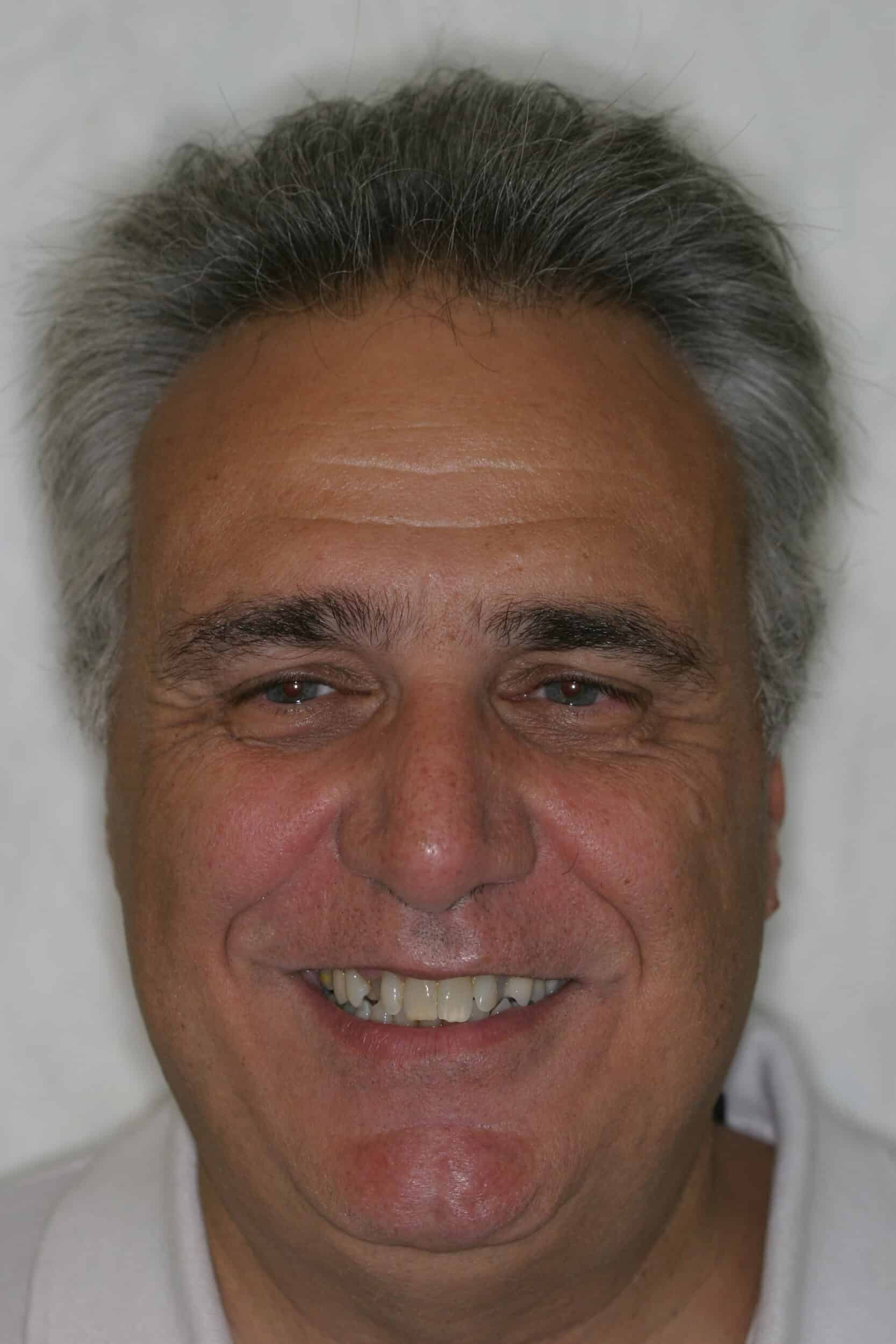 Before Image: Veneers - front