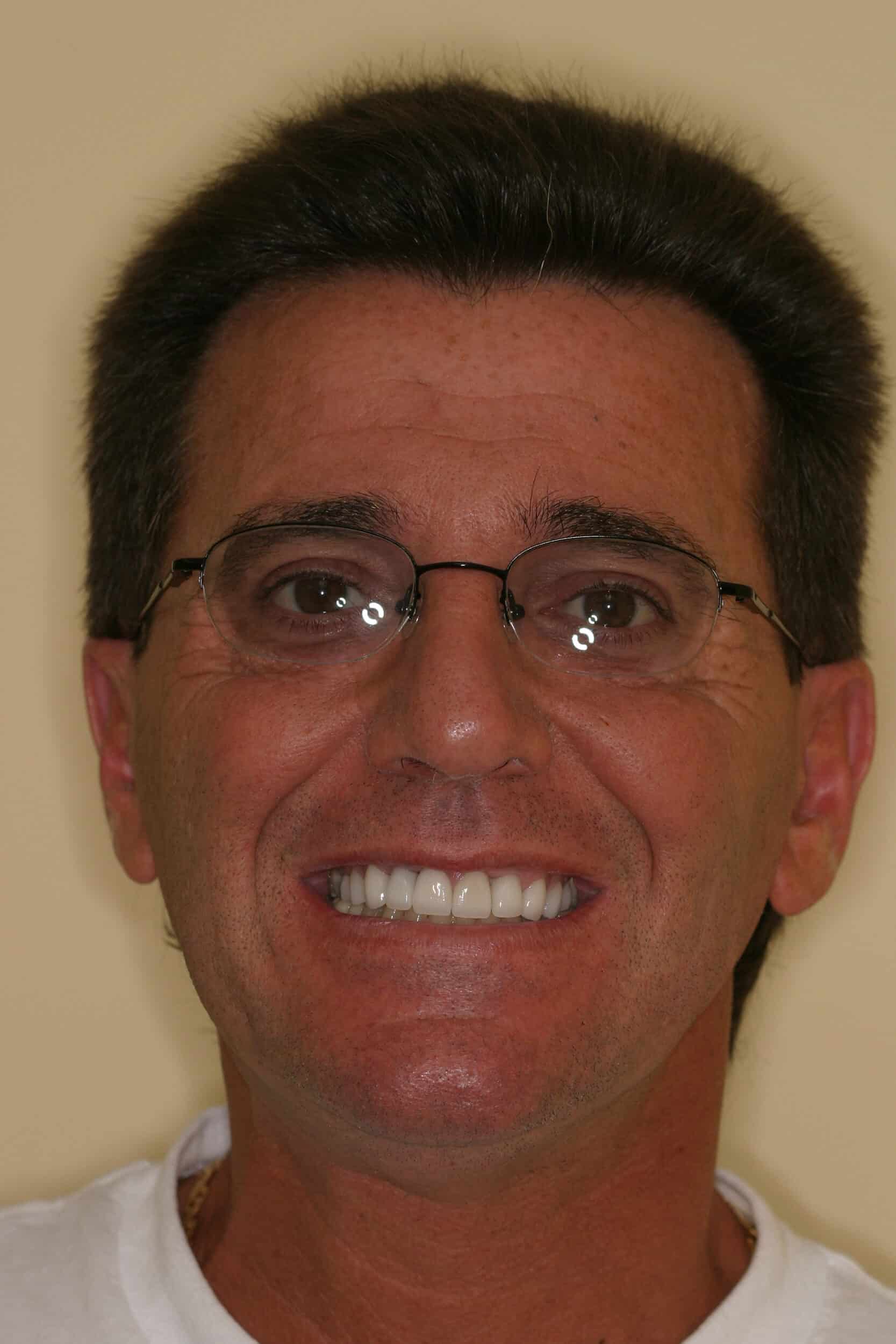 After Image: Veneers - front