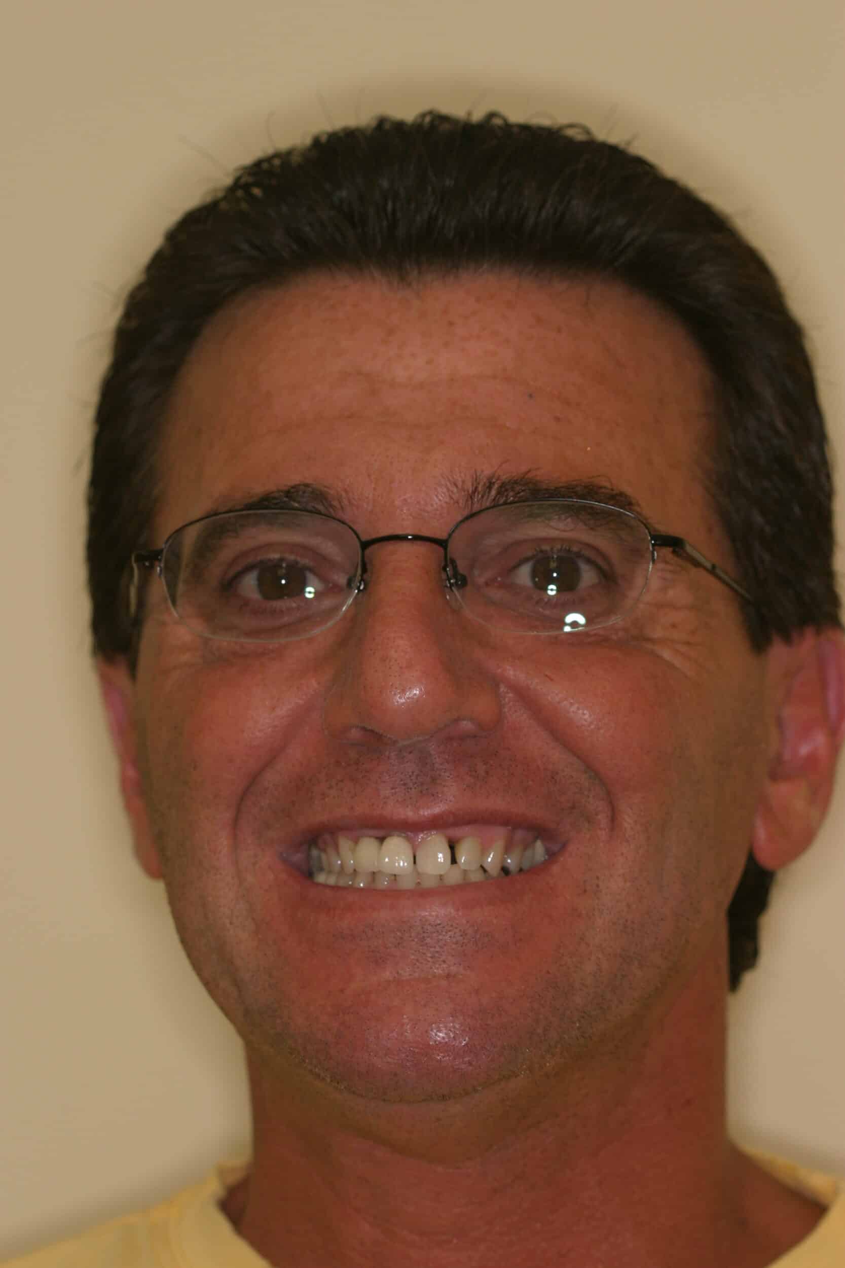 Before Image: Veneers - front