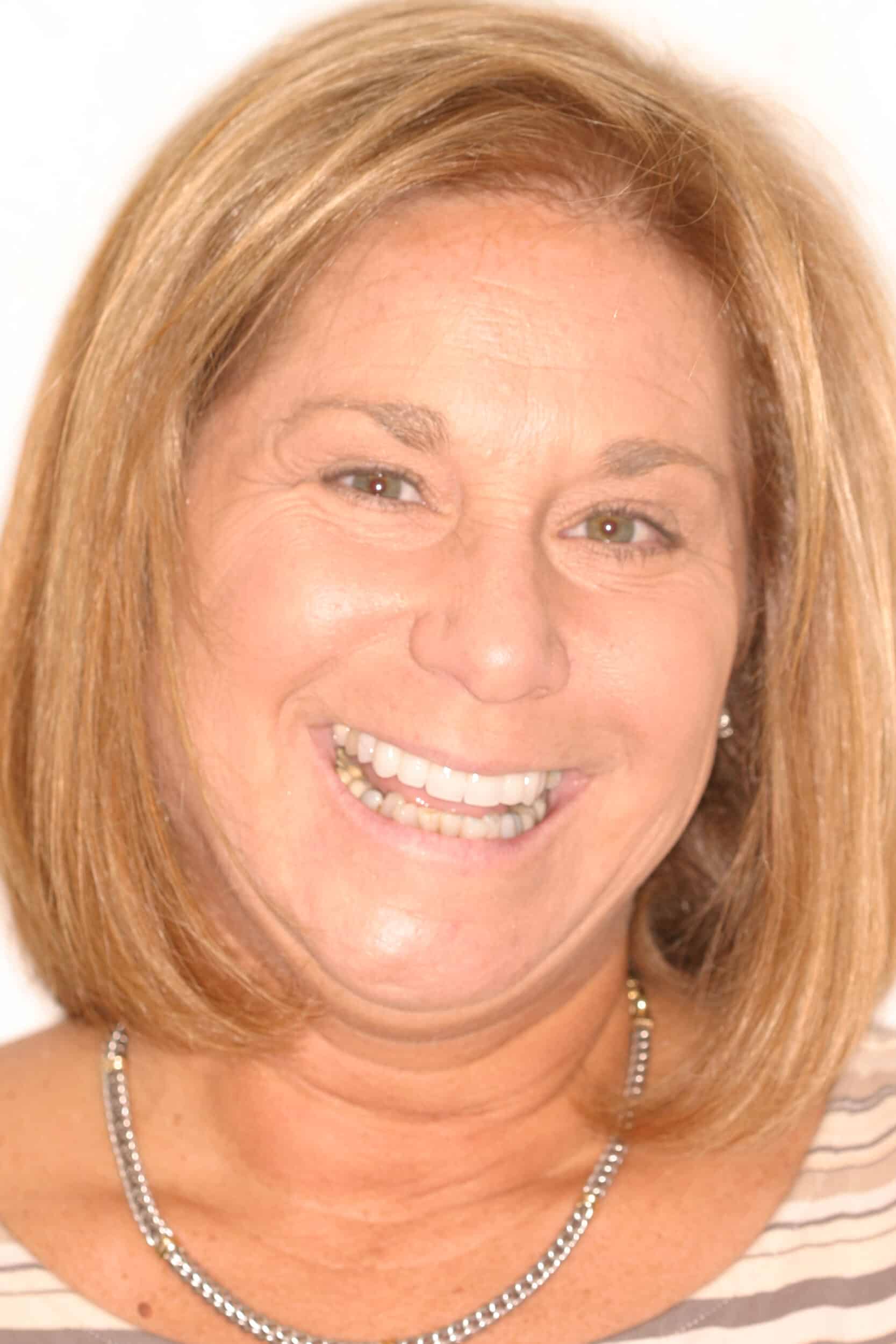 After Image: Veneers - front