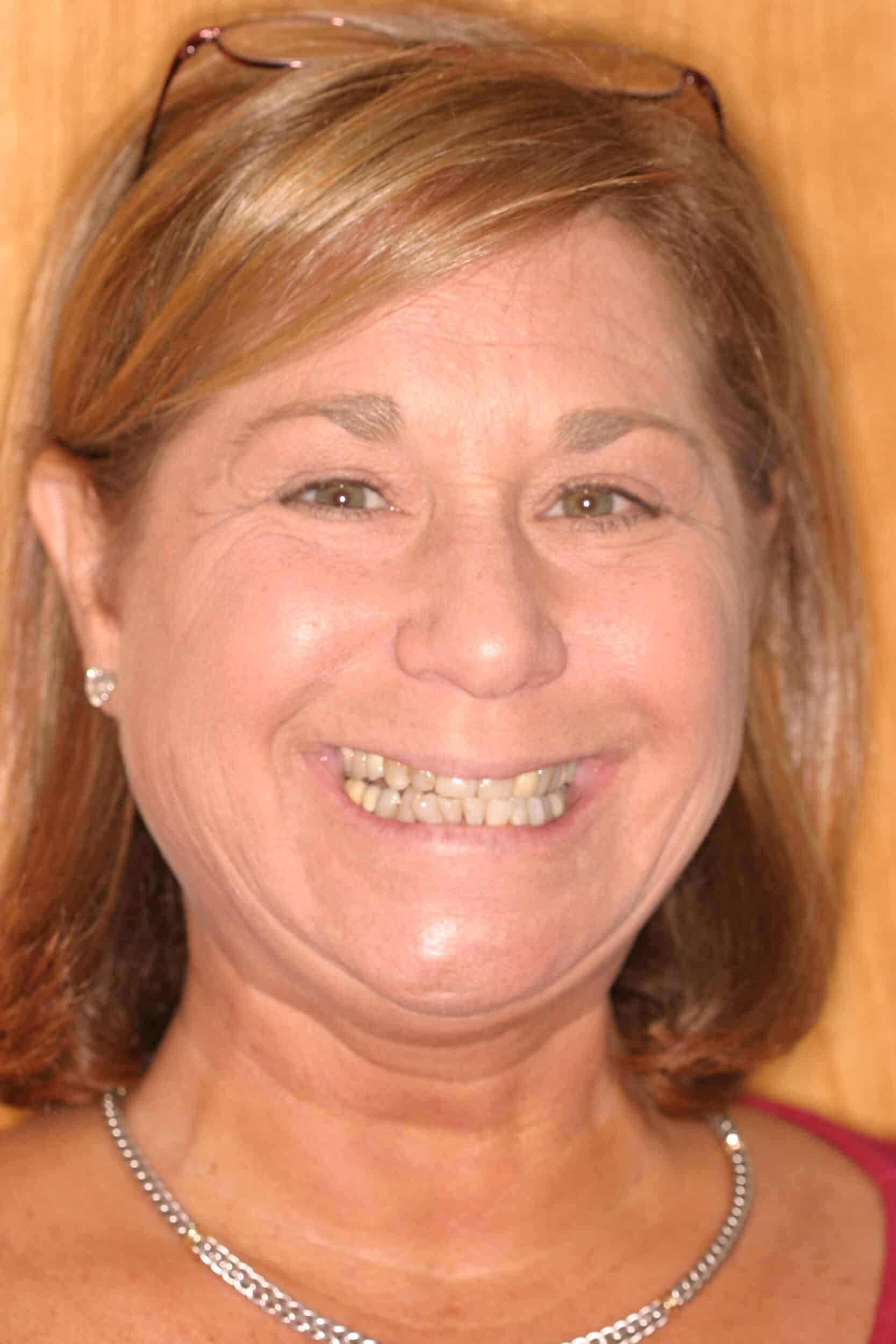 Before Image: Veneers - front