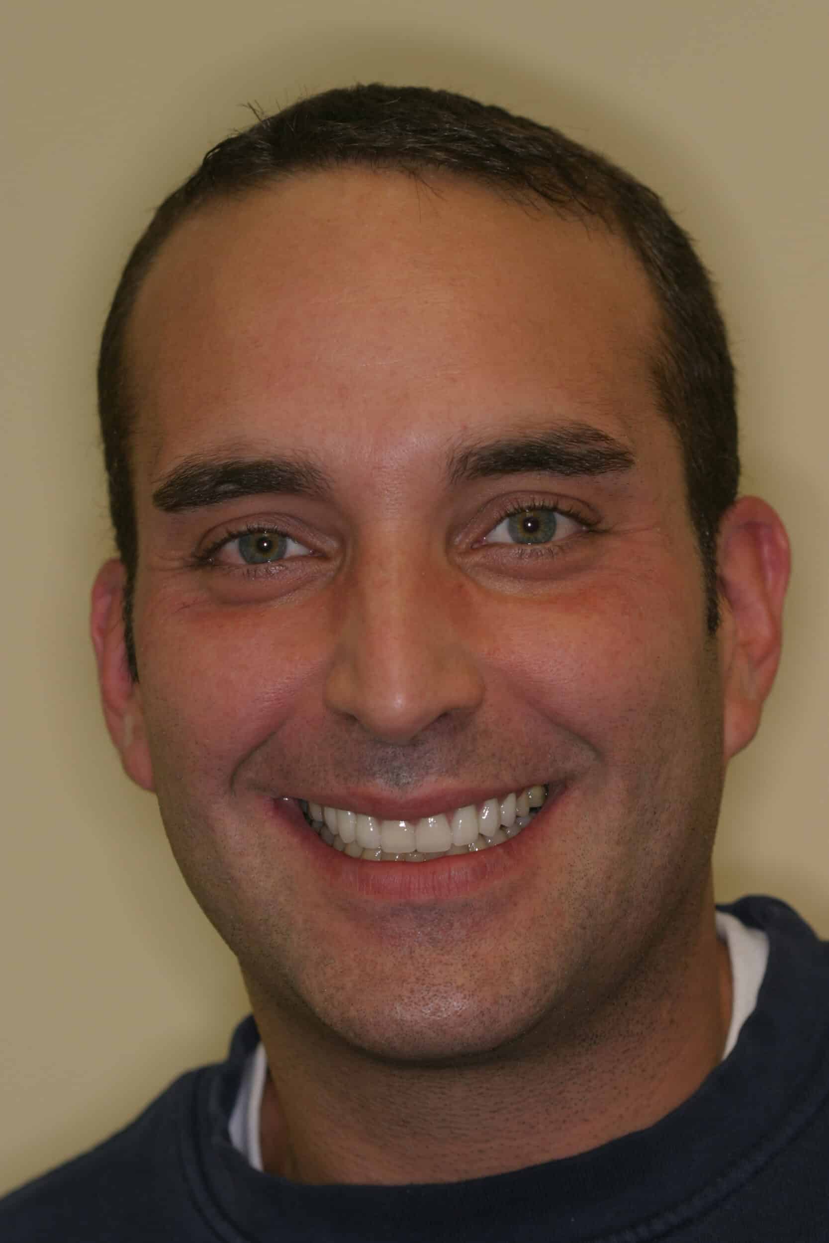 After Image: Veneers - front