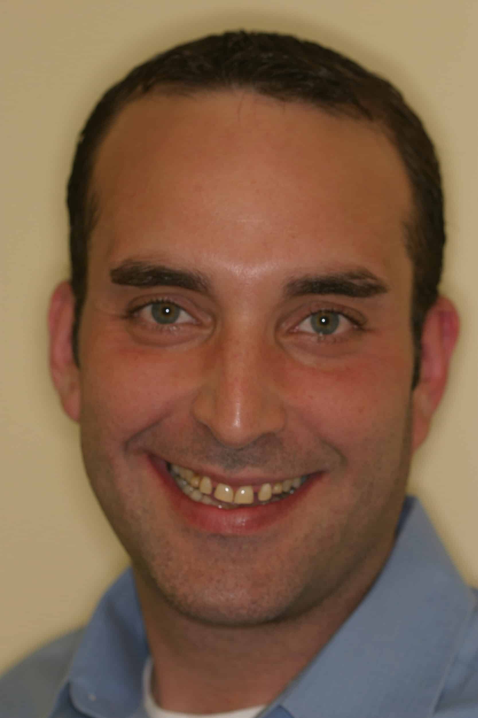 Before Image: Veneers - front