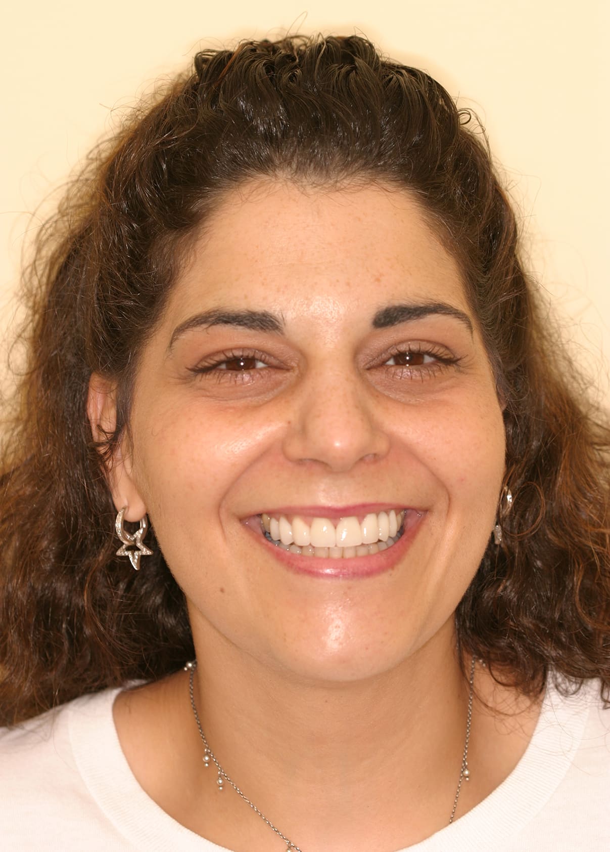 After Image: Veneers - front