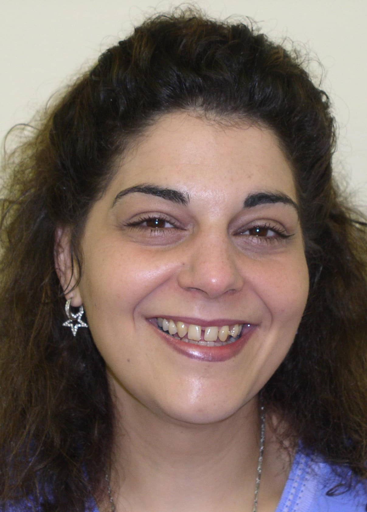 Before Image: Veneers - front