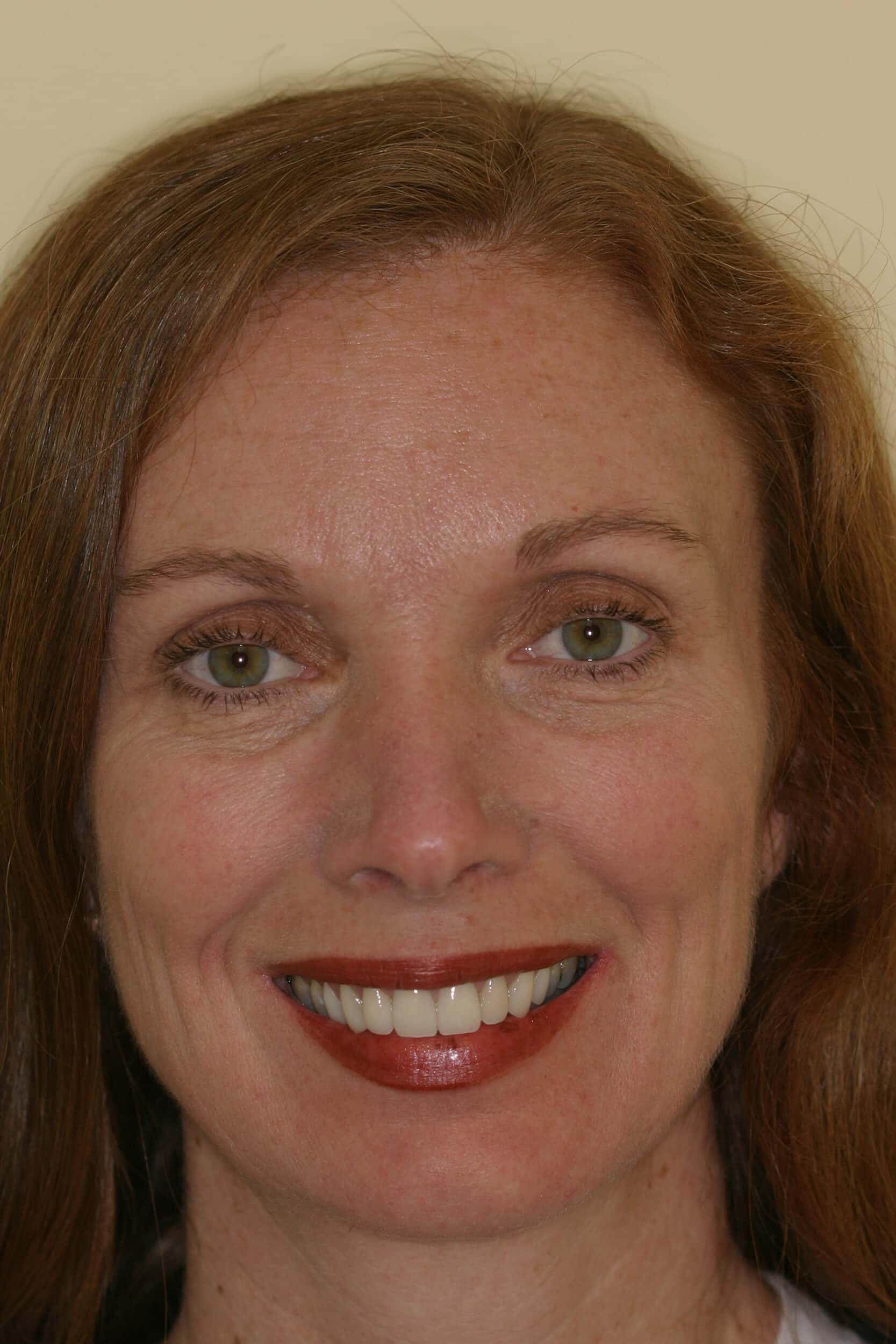 After Image: Veneers - front