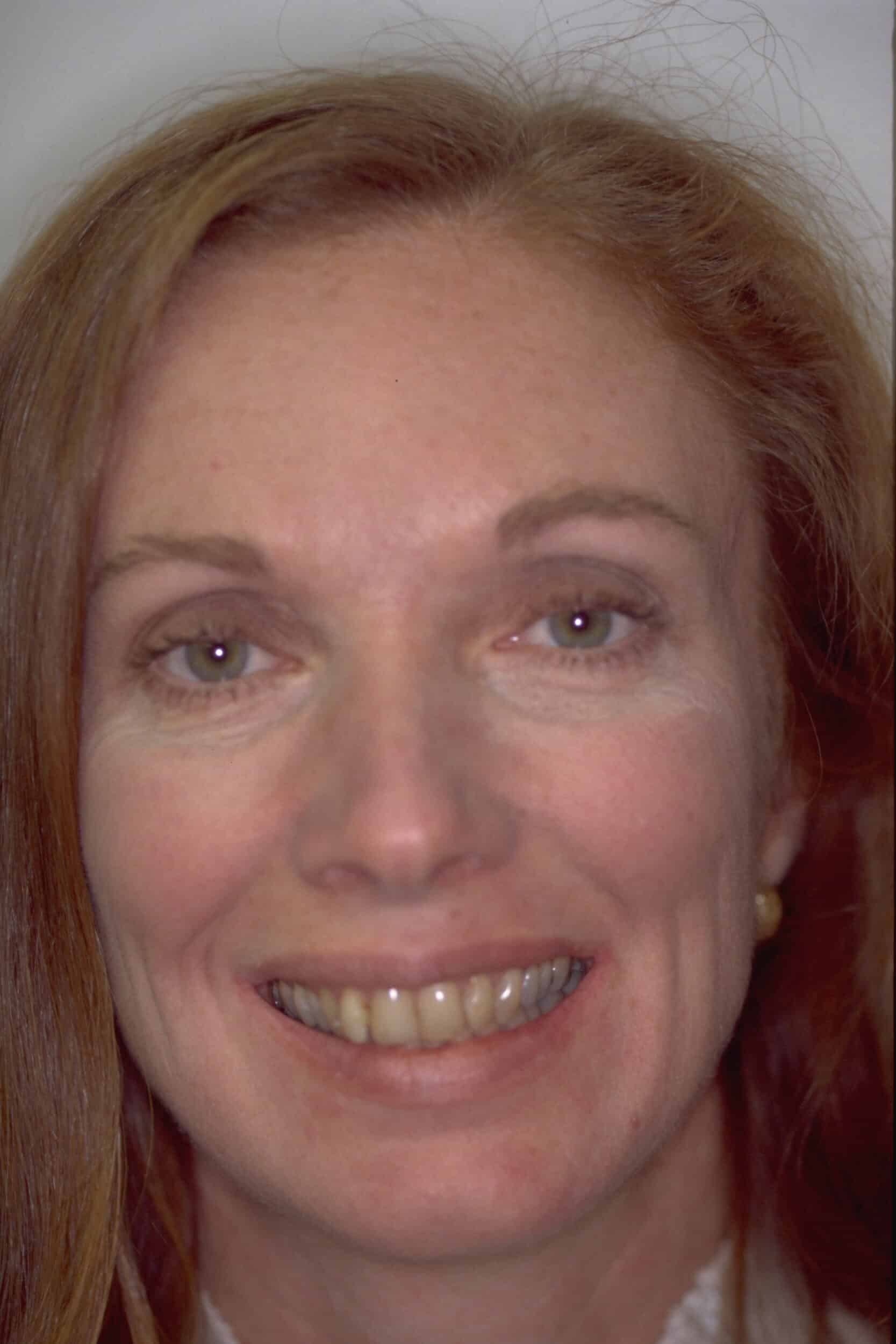 Before Image: Veneers - front