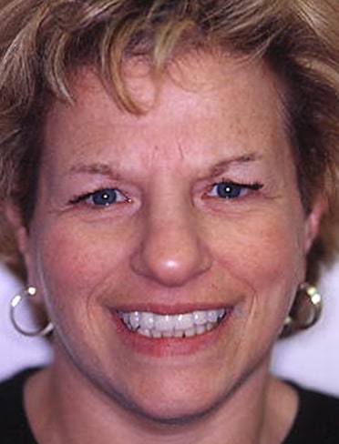 After Image: Veneers - front