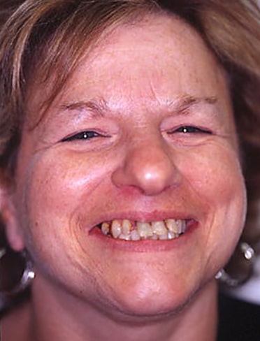 Before Image: Veneers - front