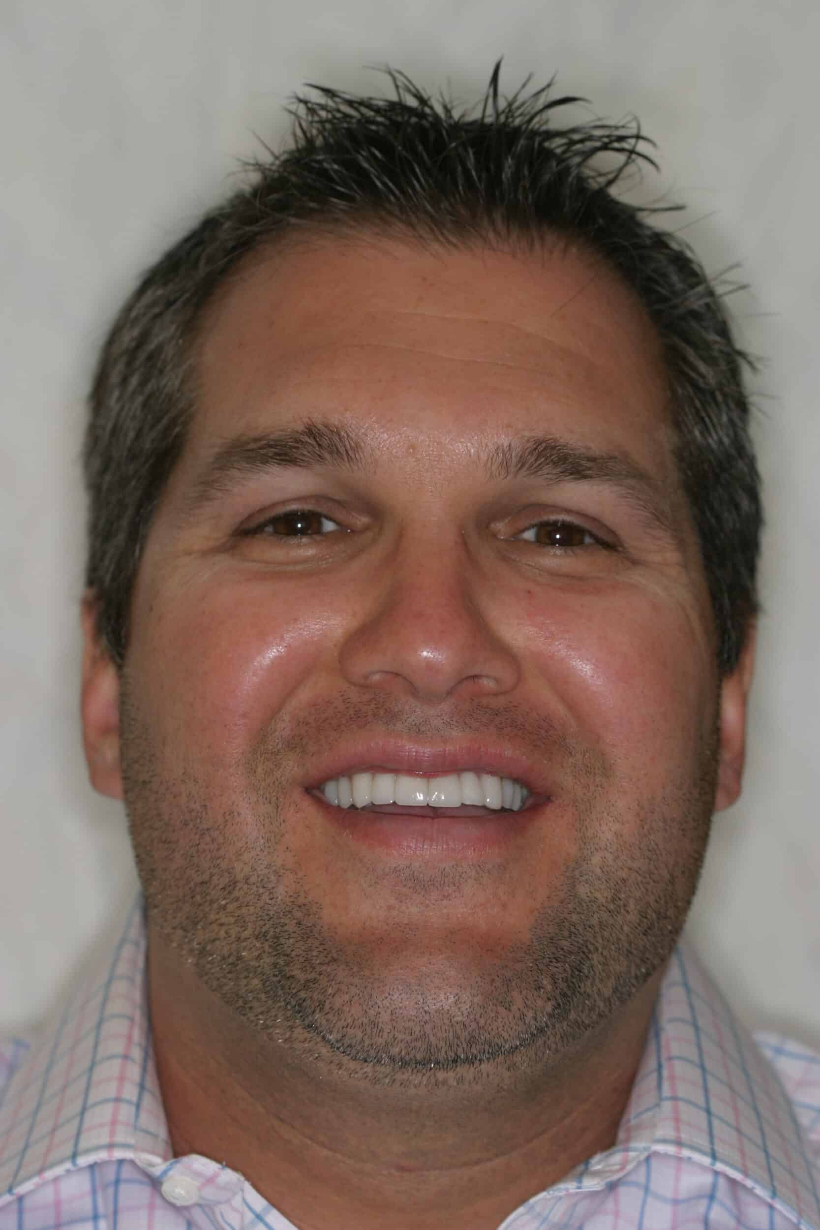 After Image: Veneers - front