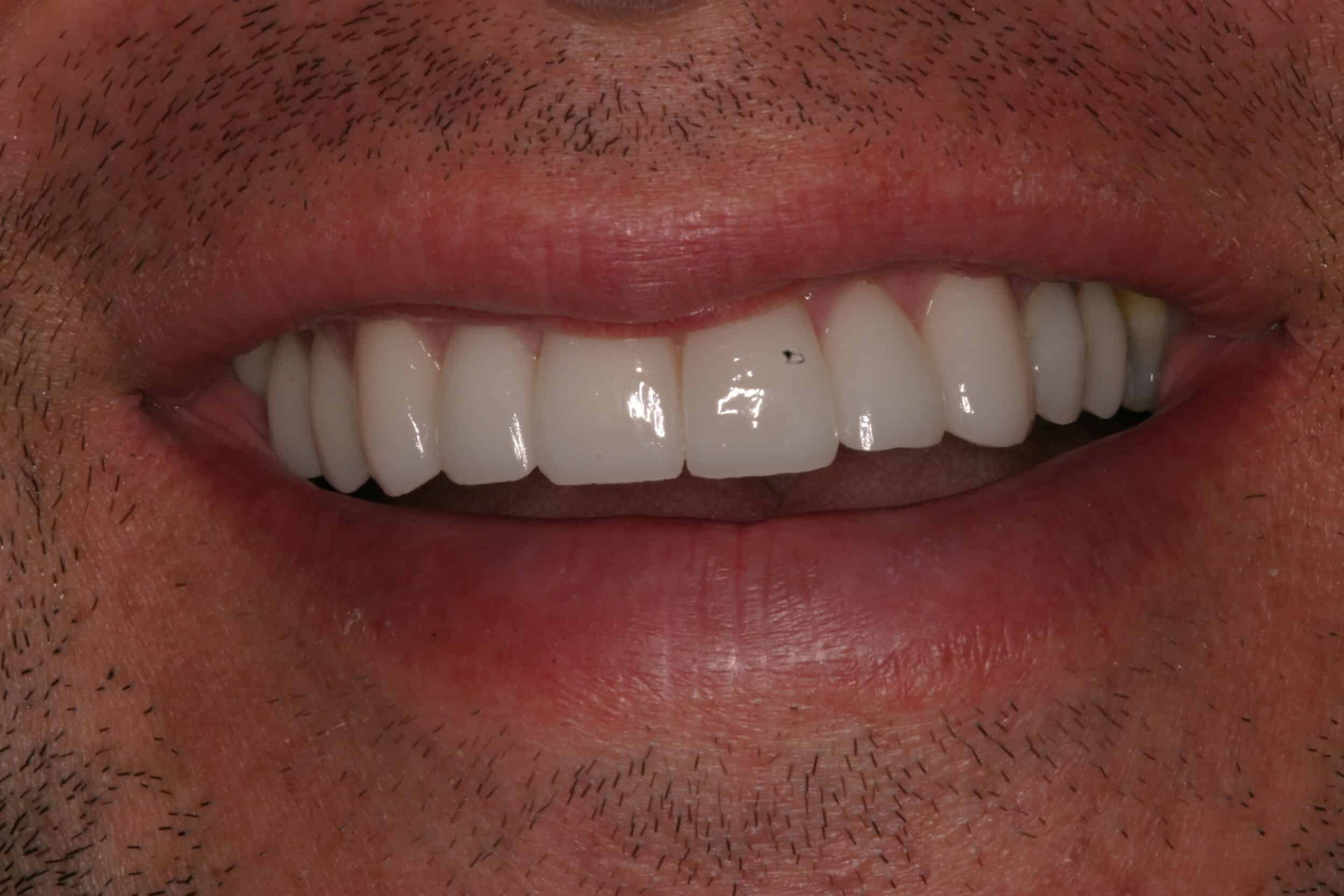 After Image: Veneers - front