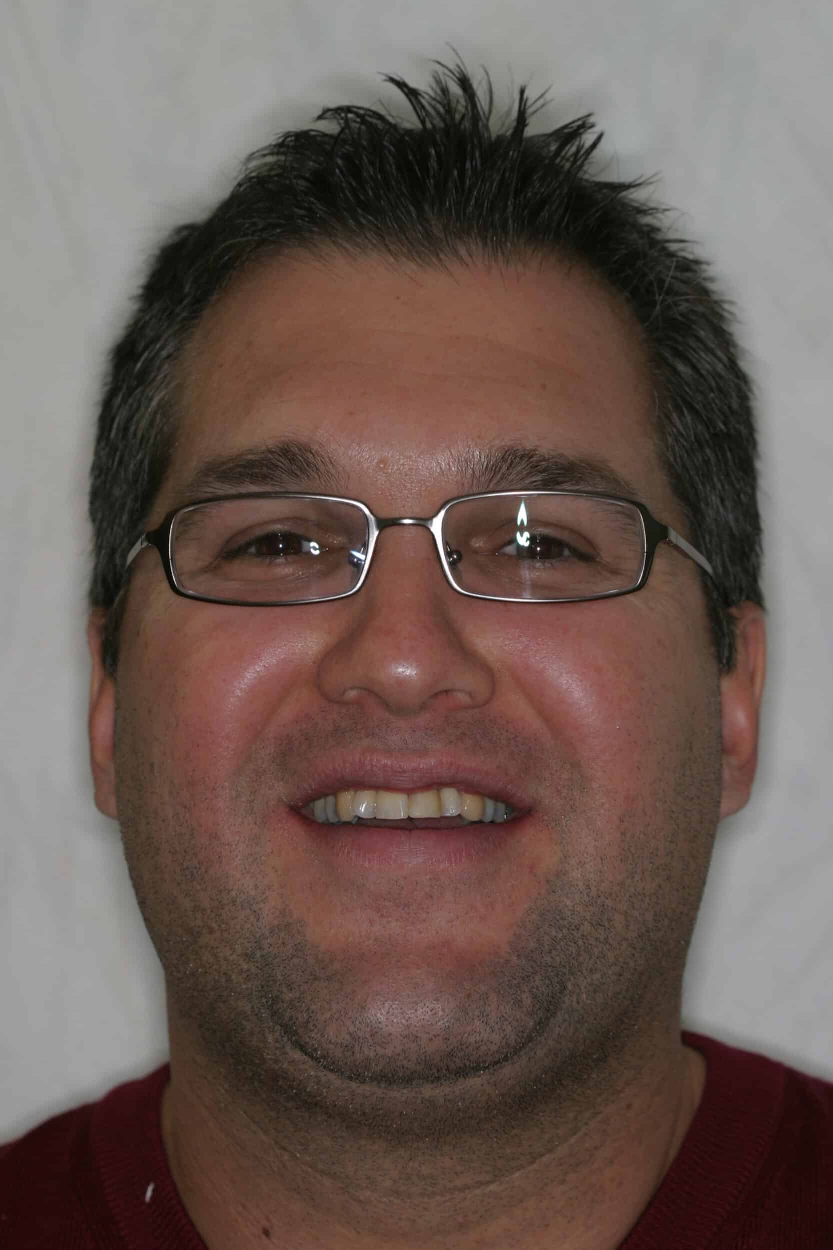 Before Image: Veneers - front