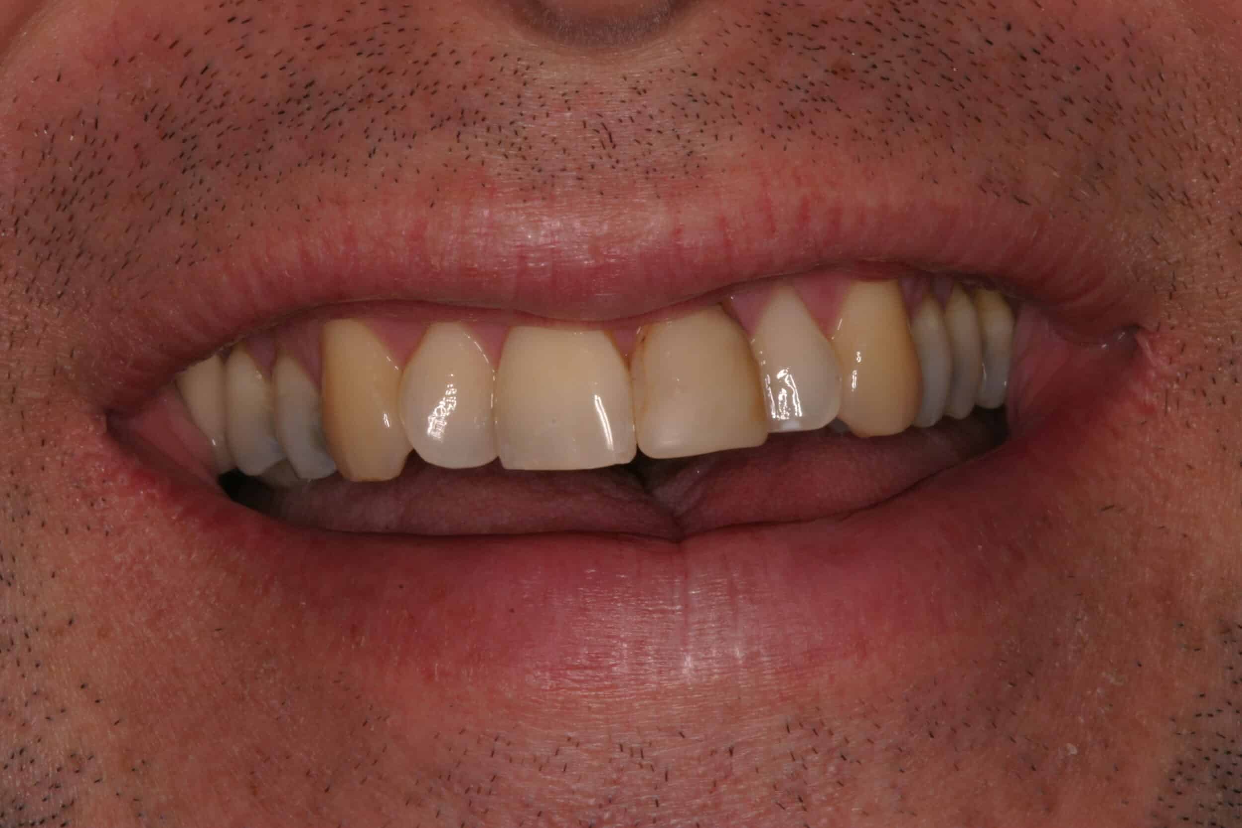 Before Image: Veneers - front