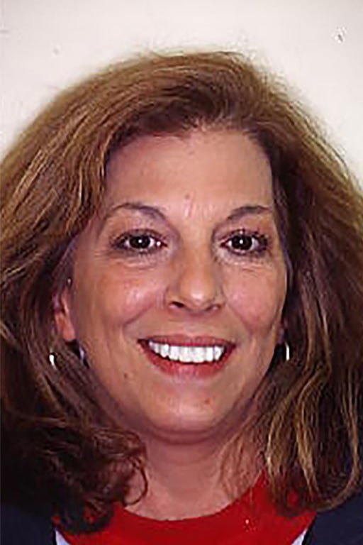 After Image: Veneers - front
