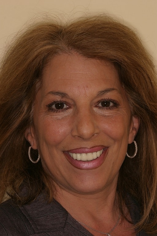 Before Image: Veneers - front