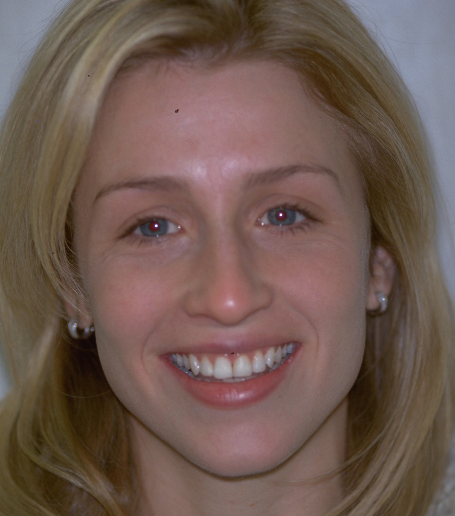Before Image: Veneers - front