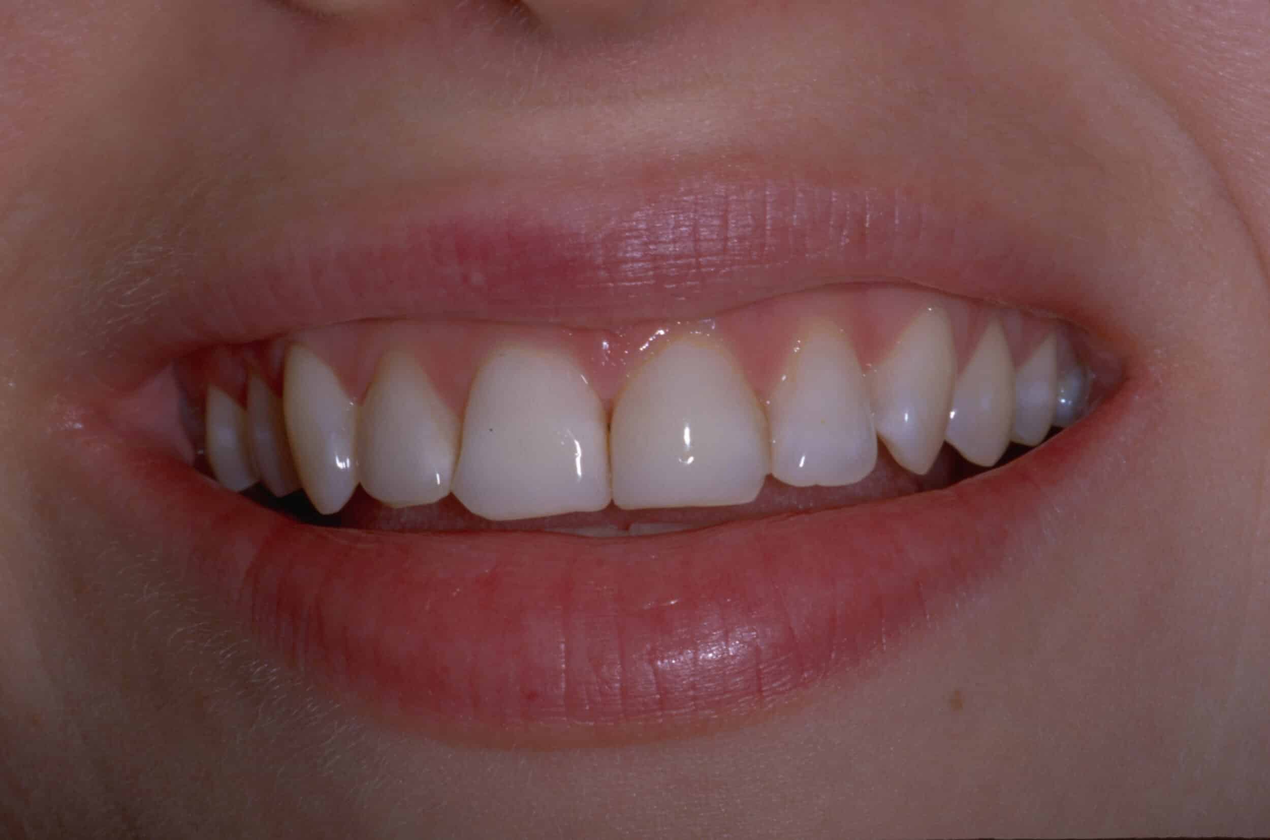Before Image: Veneers - front