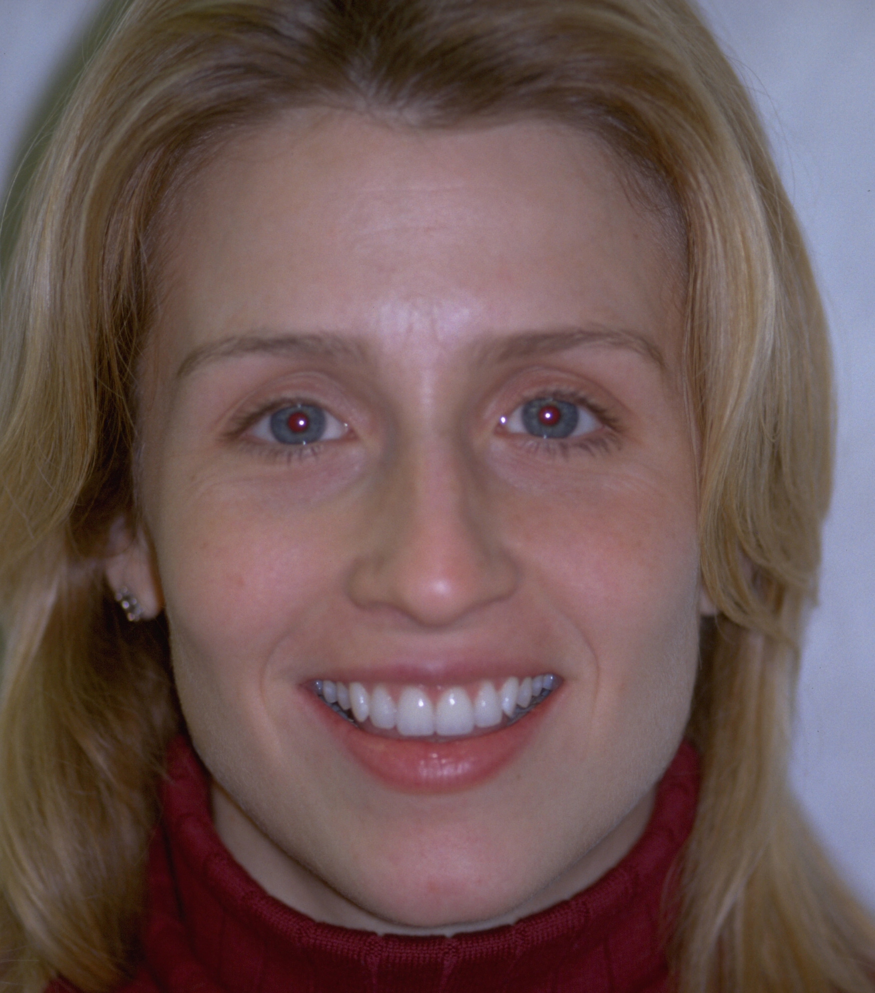 After Image: Veneers - front