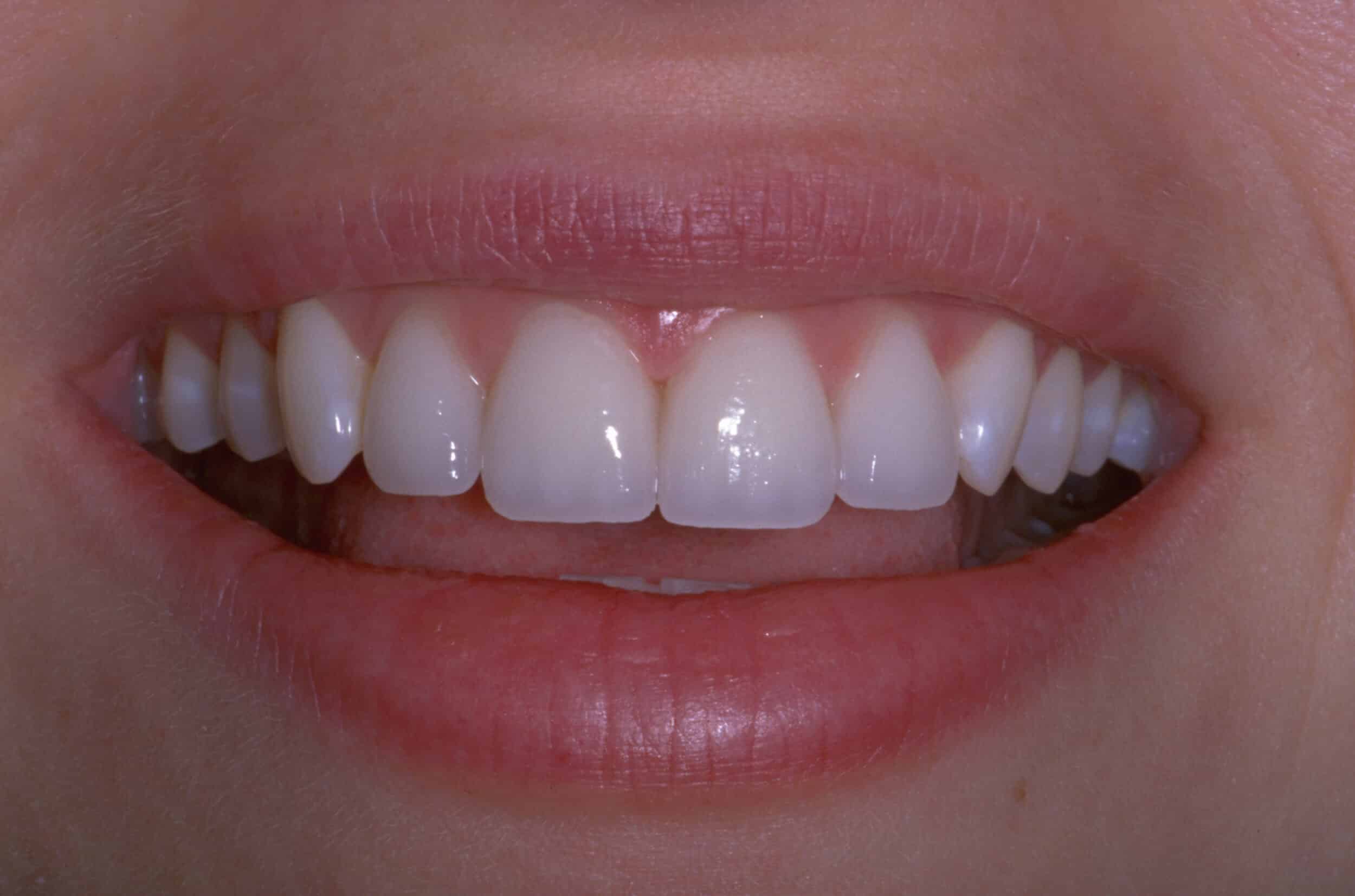 After Image: Veneers - front
