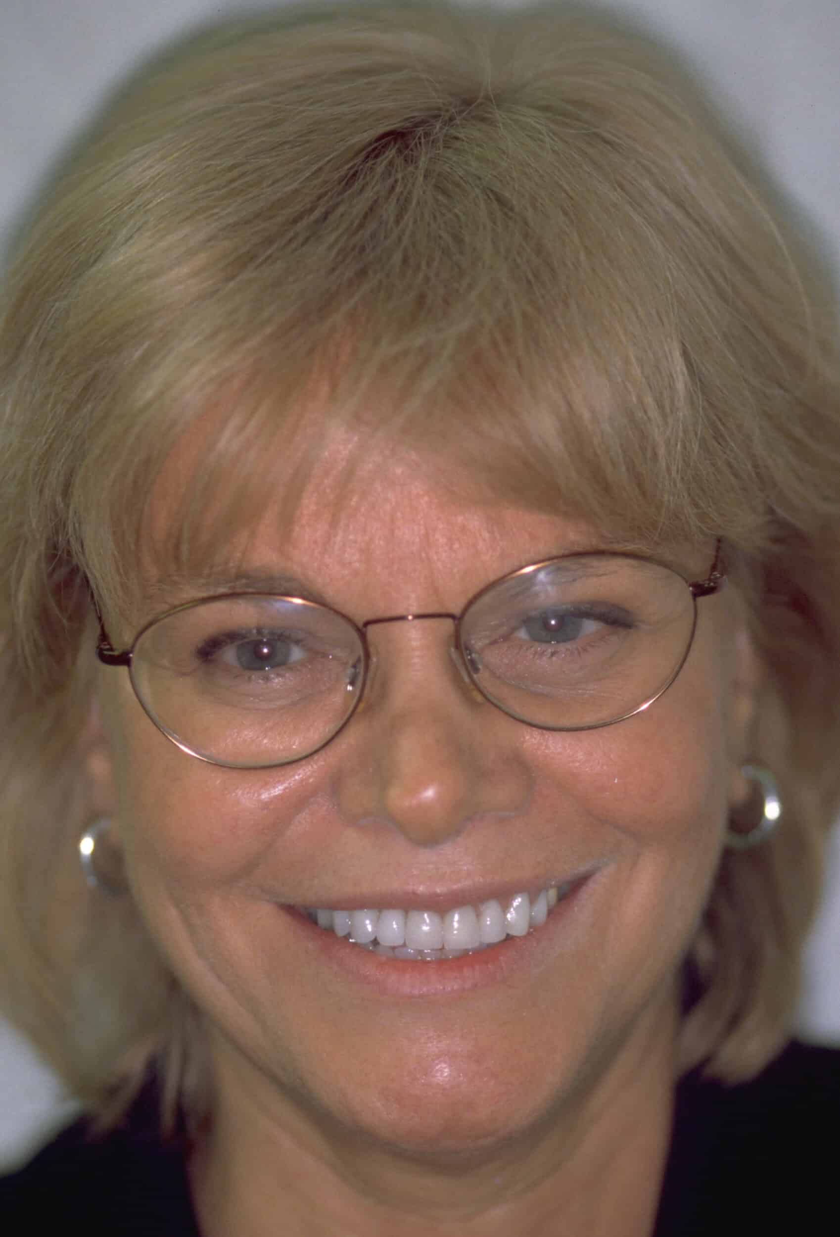 After Image: Veneers - front