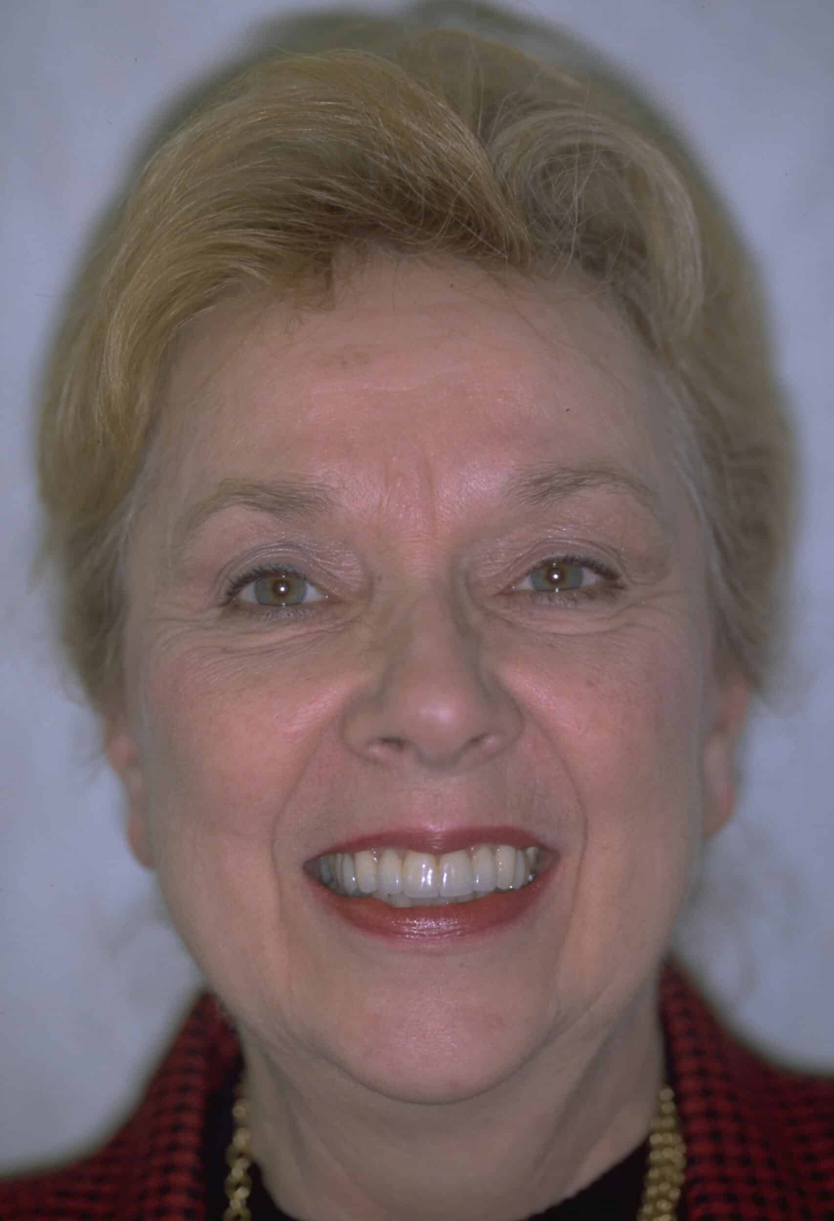 After Image: Veneers - front