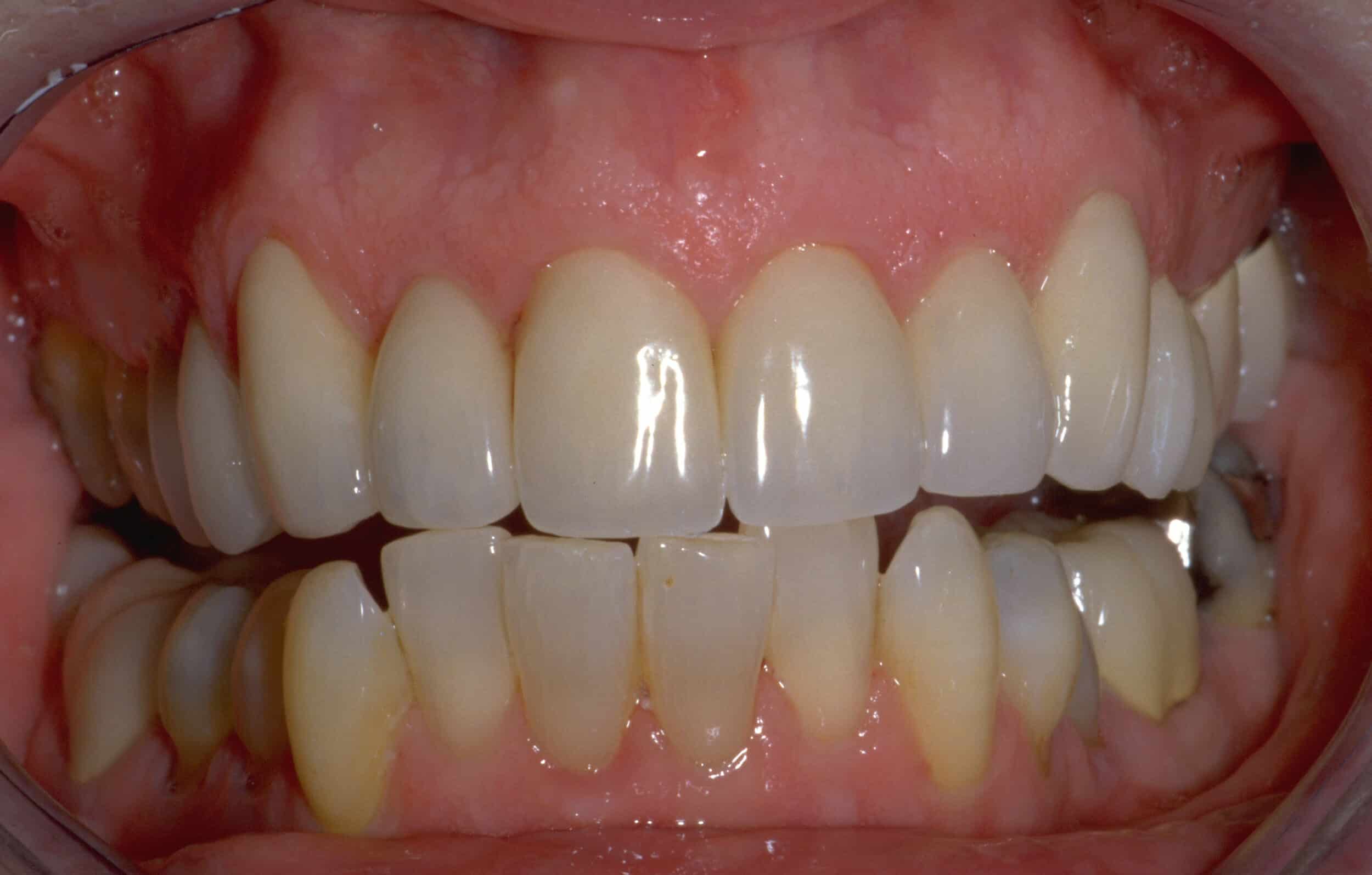 After Image: Veneers - front