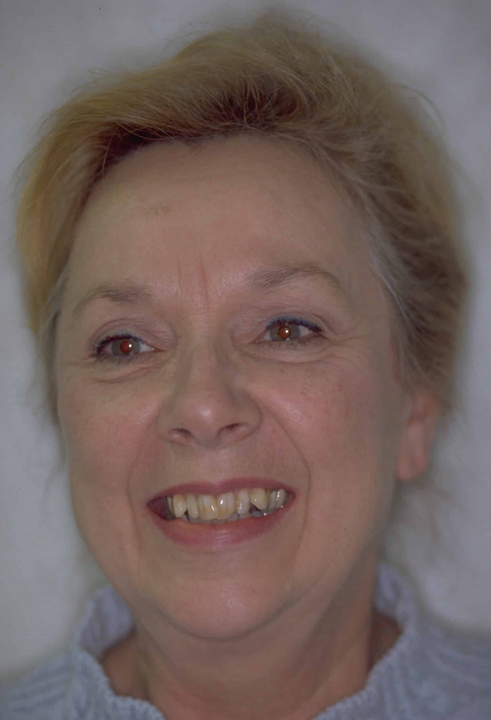 Before Image: Veneers - front