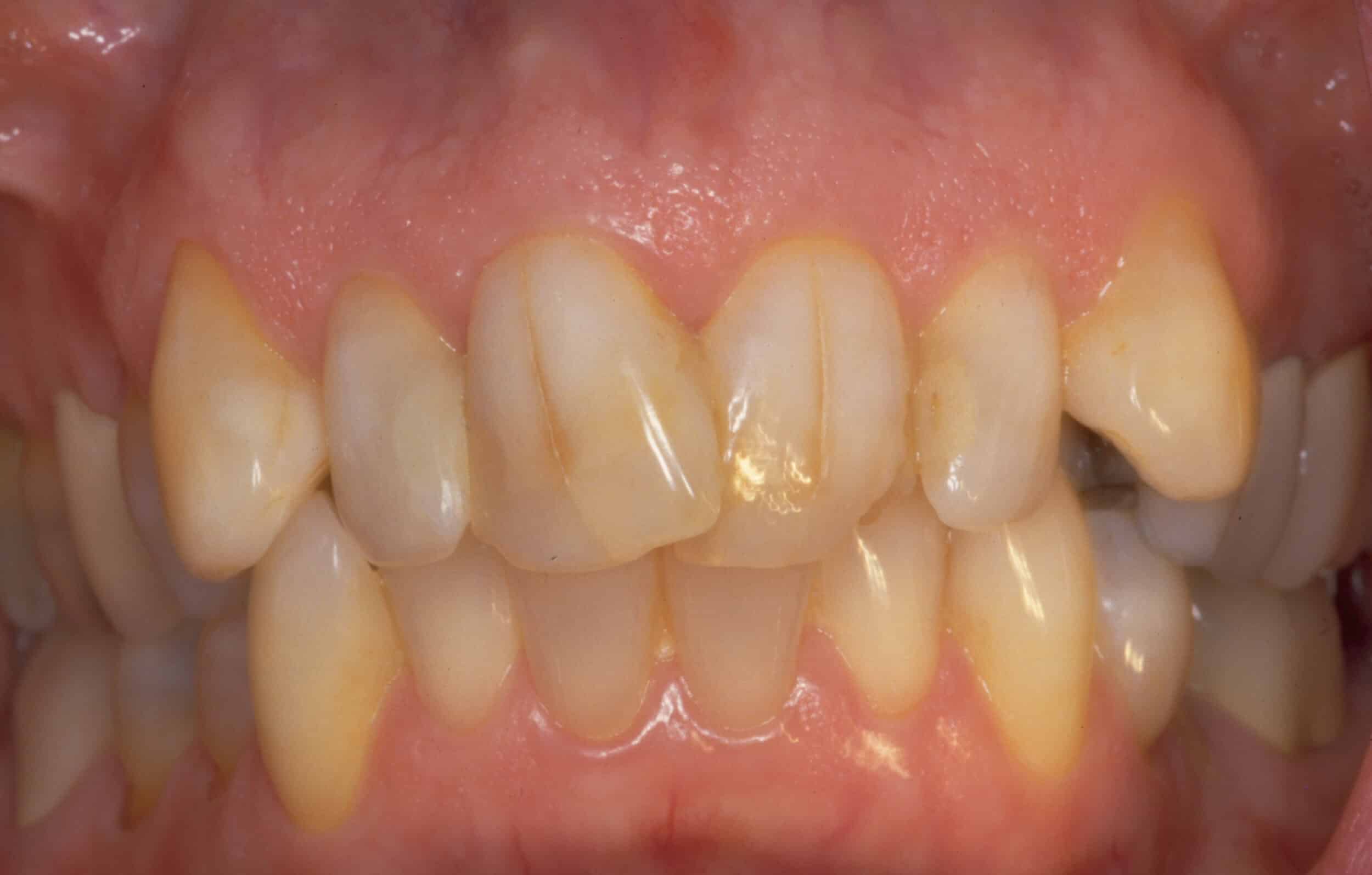 Before Image: Veneers - front
