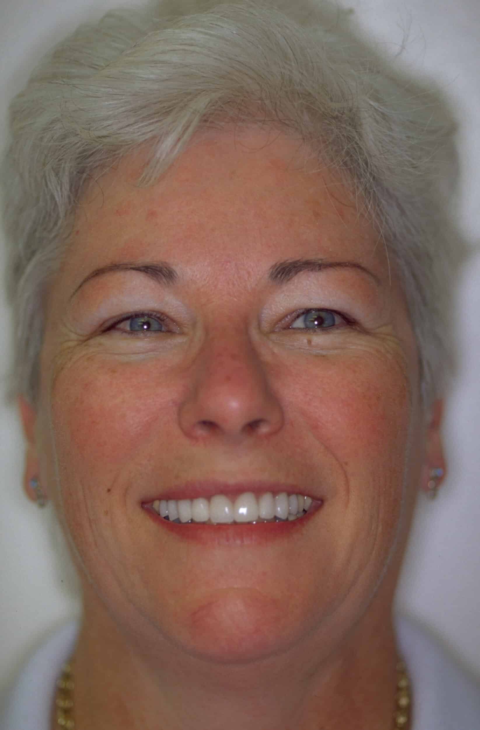 After Image: Veneers - front