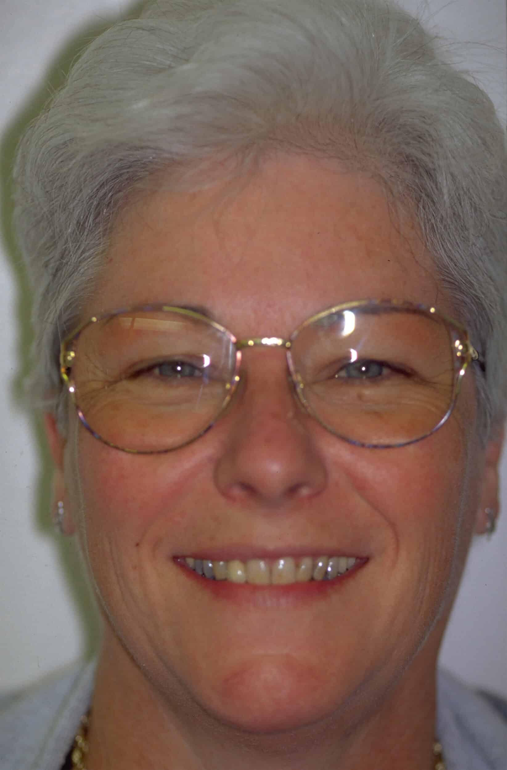 Before Image: Veneers - front