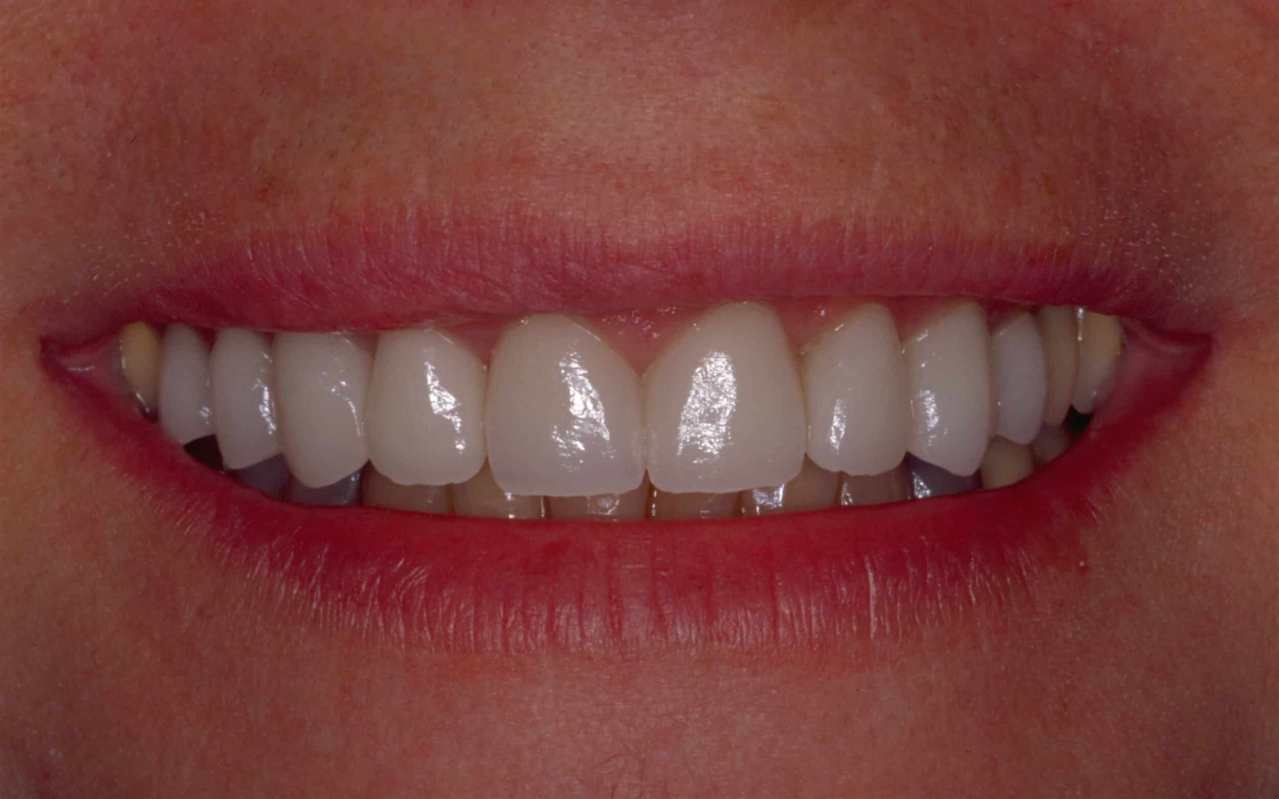 After Image: Veneers - front
