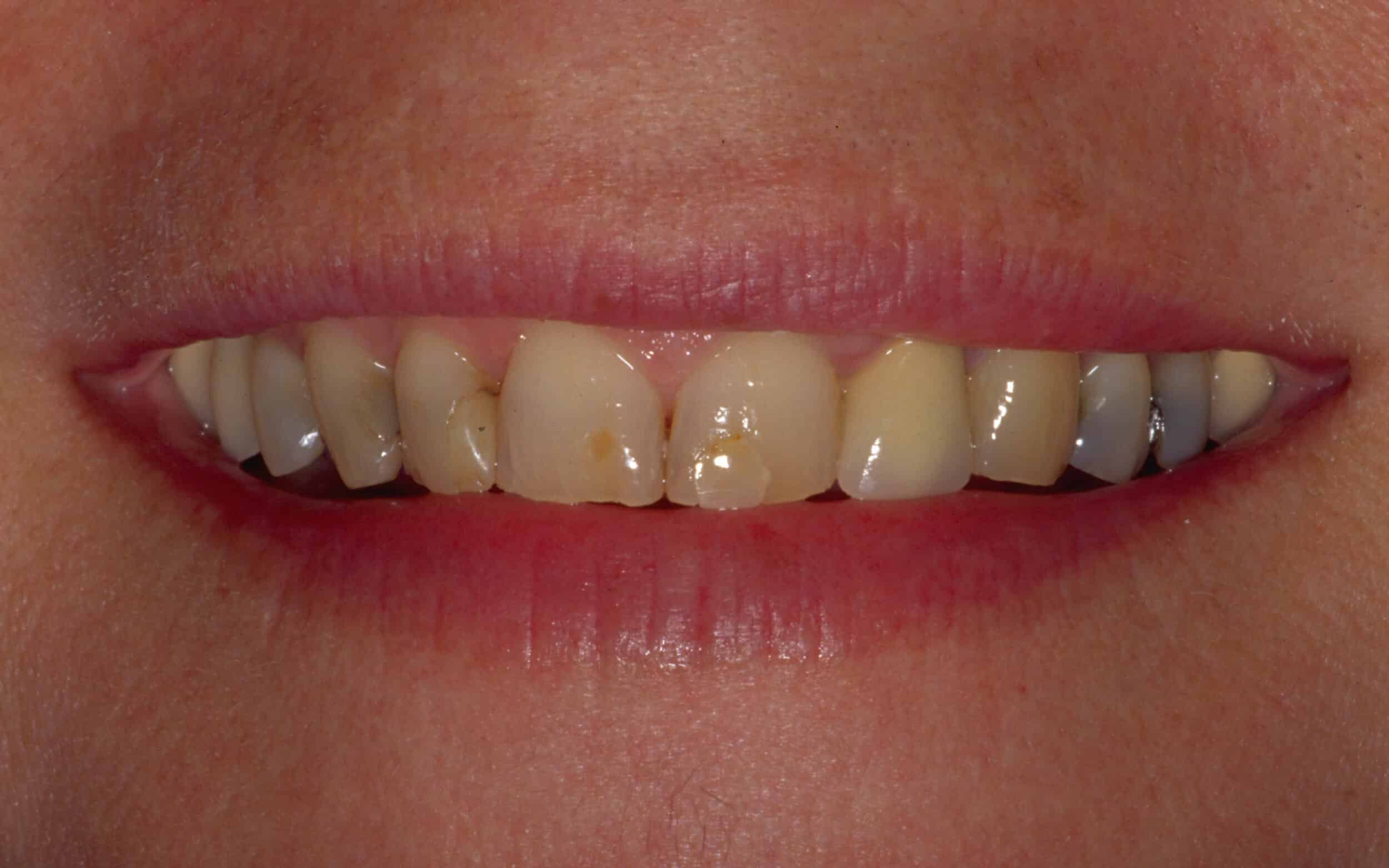 Before Image: Veneers - front