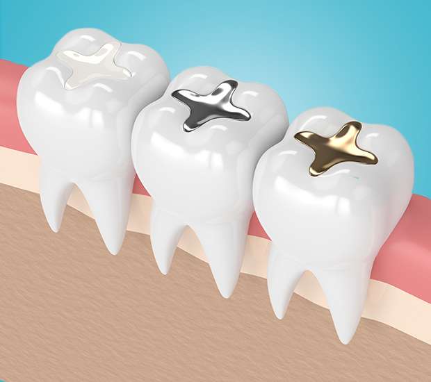 Emerson Composite Fillings