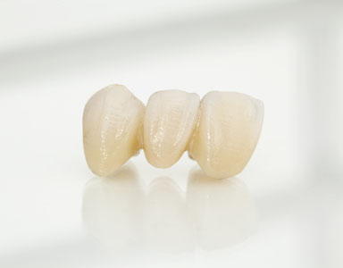 How Long Do Dental Bridges Last?