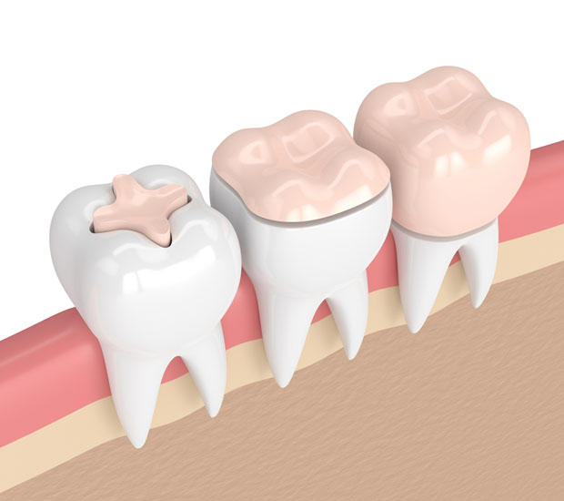 Emerson Dental Inlays and Onlays