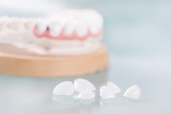 Can Dental Veneers Be Used On Top And Bottom Teeth?