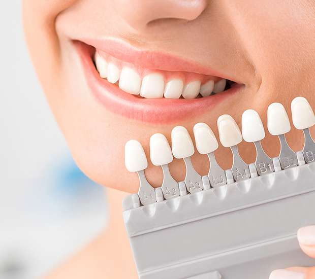 Emerson Dental Veneers and Dental Laminates