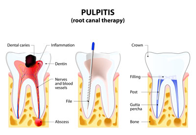 Myth Busters: &#    ;I Heard Root Canals Were &#    ;&#    ;