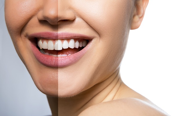 Teeth Whitening    : What Is The Ideal Shade Of White?